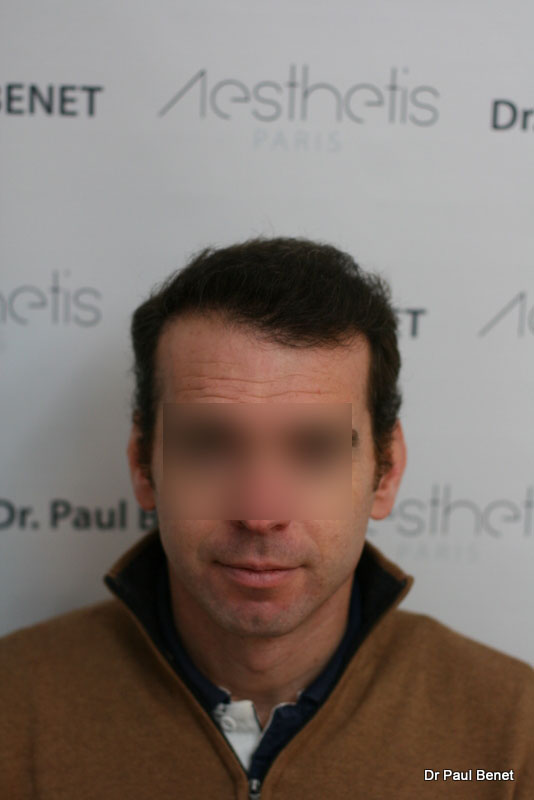 greffe de cheveux Paris 6 mois après intervention
