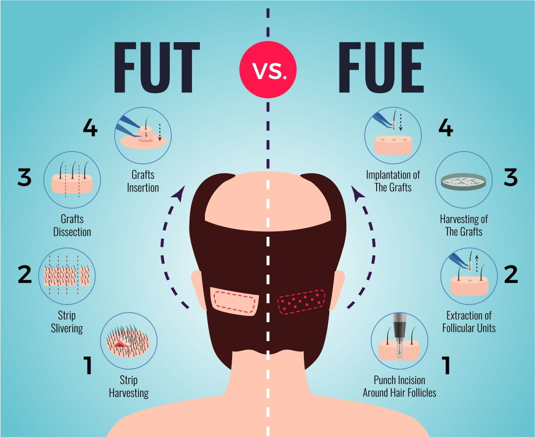 greffe de cheveux FUE vs FUT