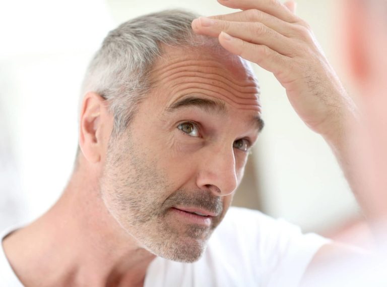 Greffe cheveux homme à Paris