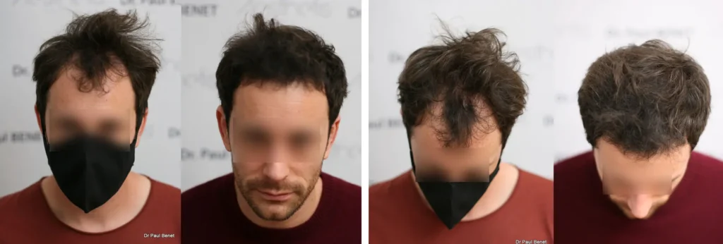 Eric 12 mois avant après greffe cheveux